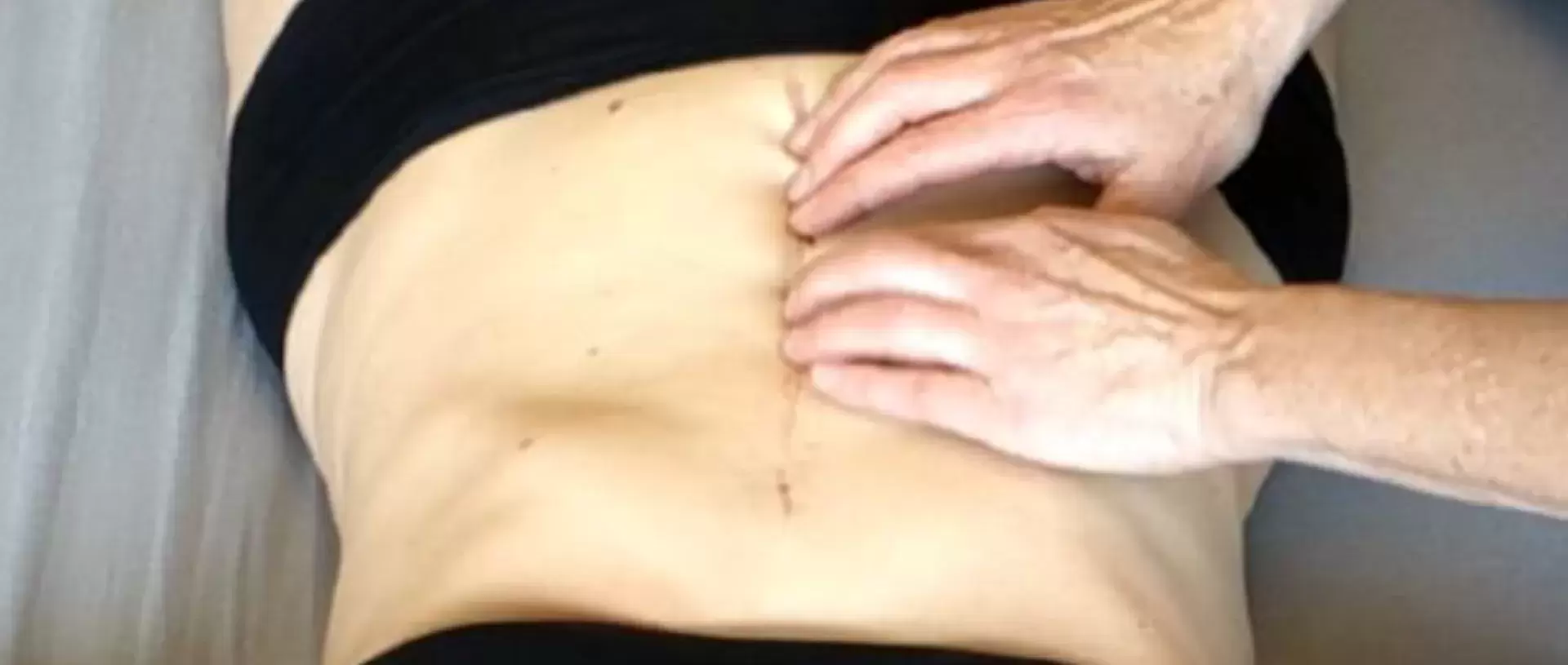 Rolﬁng® und Narben