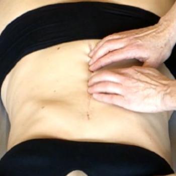 Rolﬁng® and Scars
